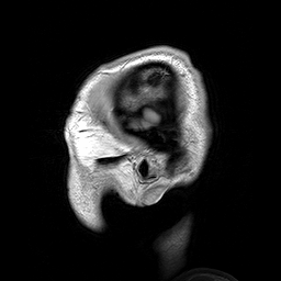 Parasagittal_MRI_of_human_head_in_patient_with_benign_familial_macrocephaly_prior_to_brain_injury_(ANIMATED)