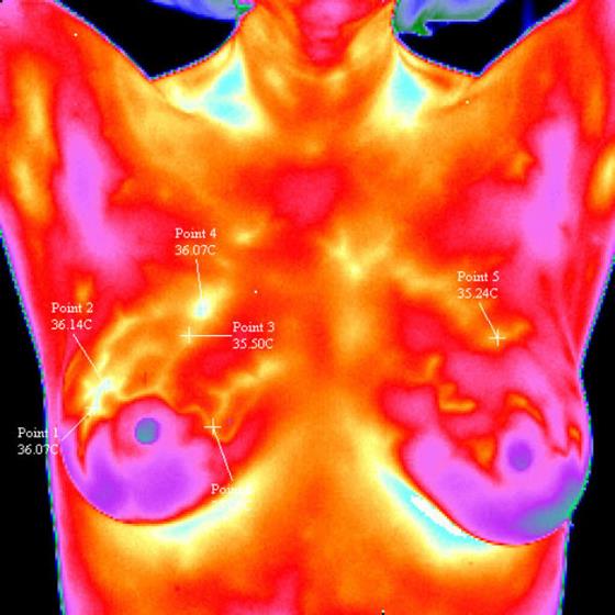 breast-cancer-thermography[1]