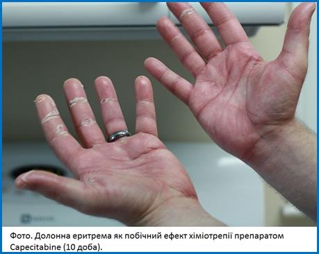 800px-Hand-foot_Syndrome