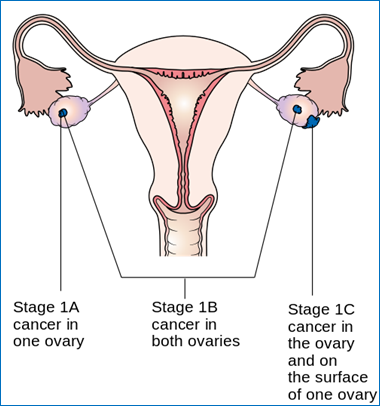 Diagram_showing_stage_1_ovarian_cancer_CRUK_193.svg