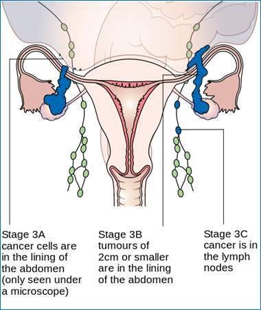 Diagram_showing_stage_3A_to_3C_ovarian_cancer_CRUK_225.svg