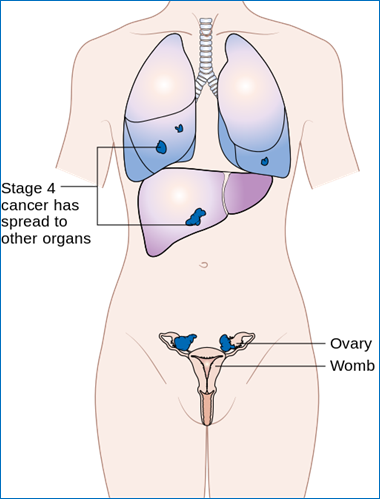 Diagram_showing_stage_4_ovarian_cancer_CRUK_233.svg