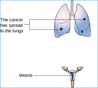 Diagram_showing_stage_3_choriocarcinoma_CRUK_220.svg