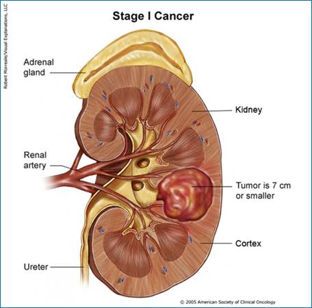 kidney_stage1_print