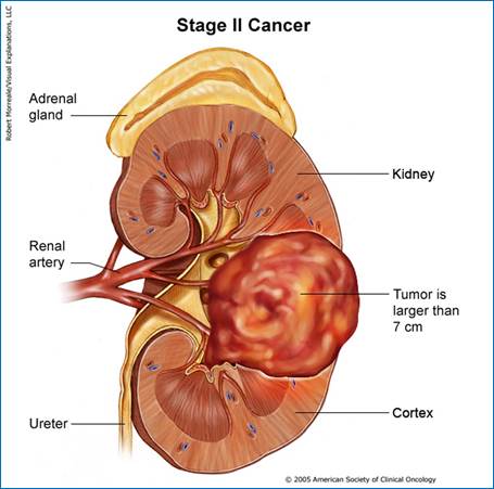 kidney_stage2_print