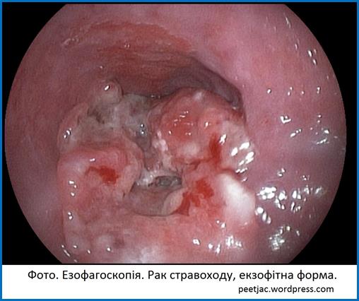 oesophageal cancer_