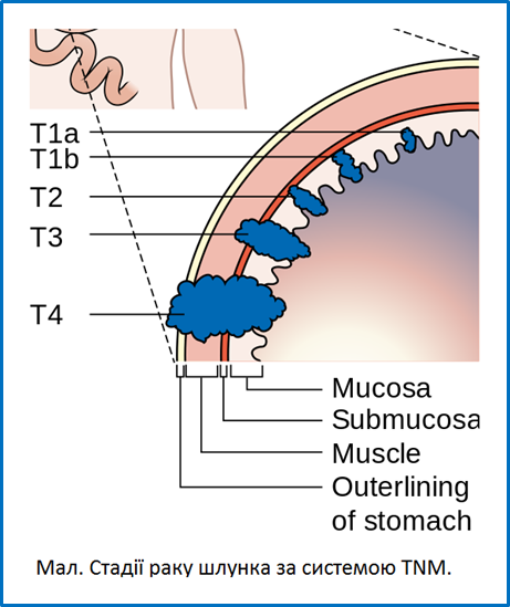 Diagram_showing_the_T_stages_of_stomach_cancer_CRUK_374.svg