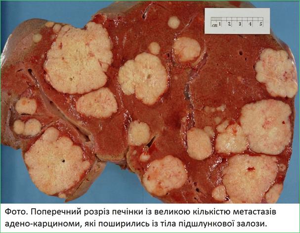 Secondary_tumor_deposits_in_the_liver_from_a_primary_cancer_of_the_pancreas