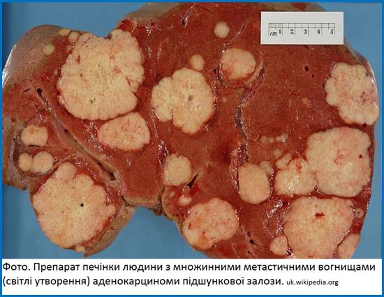 Secondary_tumor_deposits_in_the_liver_from