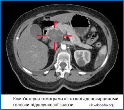 Carcinoma-pancreas