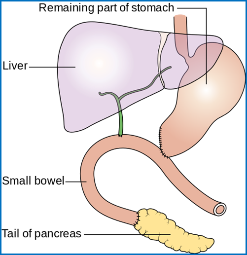 Diagram_showing_how_the_pancreas_and_bowel_is_joined_back_together_after_a_Whipple's_operation_CRUK_140.svg