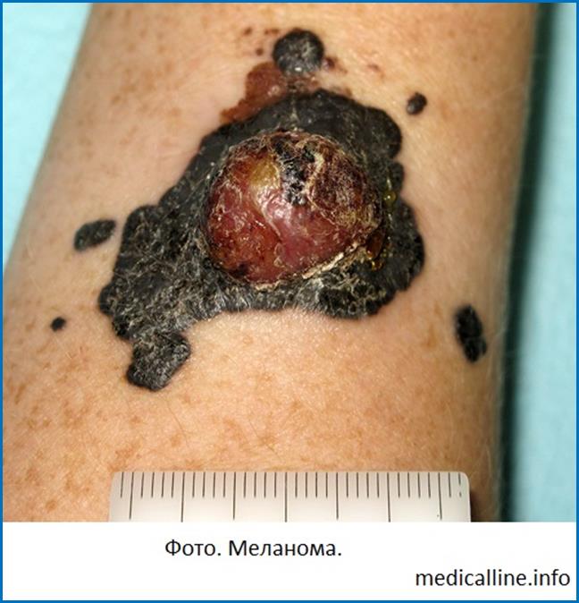 melanoma1