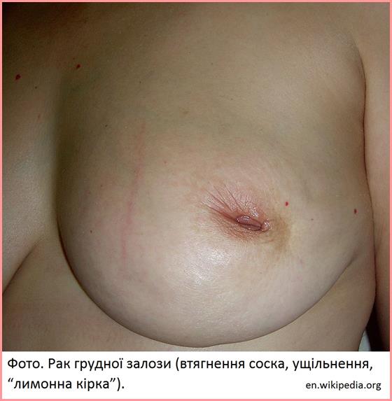 Breast cancer_